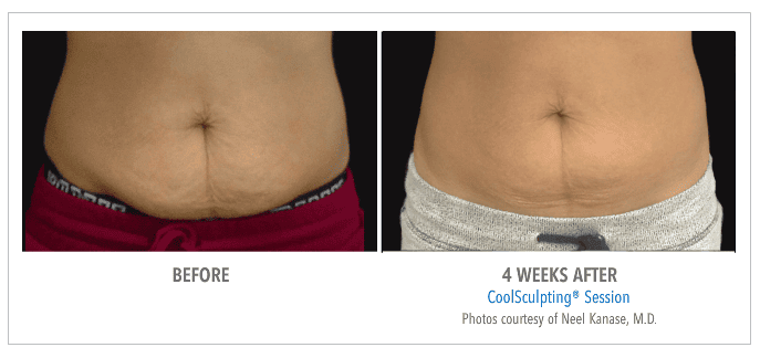 Coolsculpting Before & After courtesy of Neel Kanase M.D.