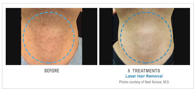 Laser Hair Removal Before & After Photos - Neck