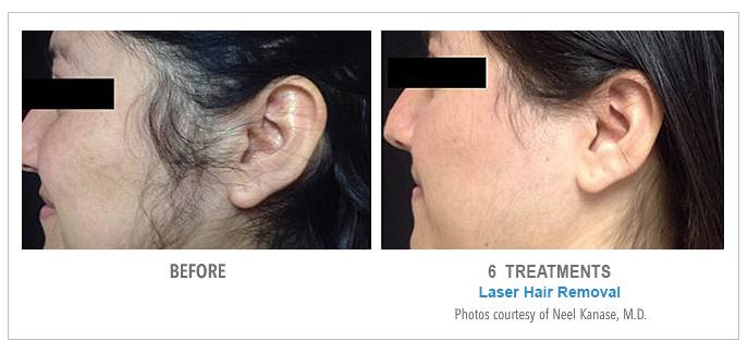 Laser Hair Removal Sidenburns