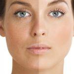 Iv Hydration and melasma