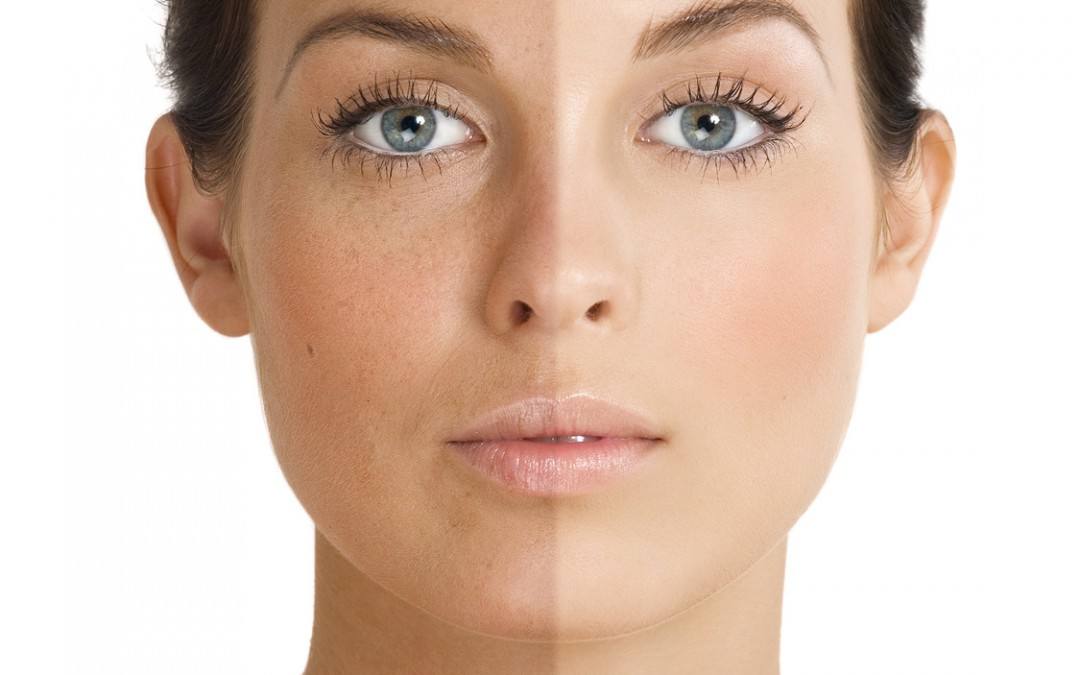 Iv Hydration and melasma