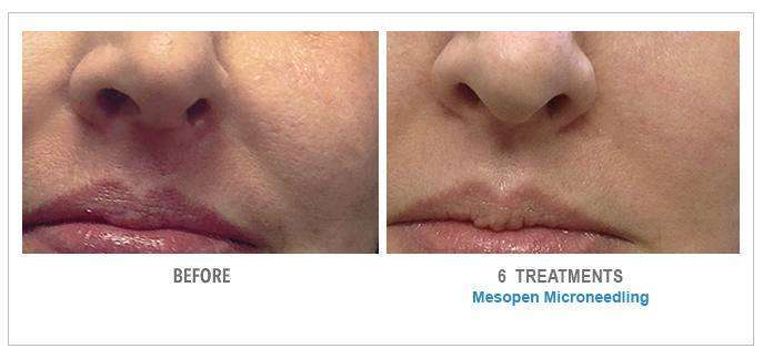Microneedling