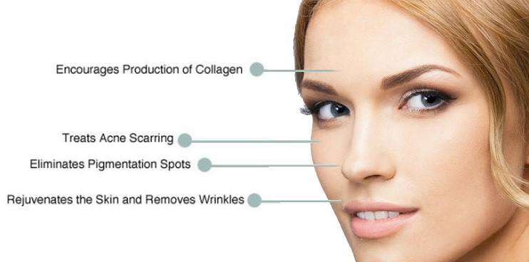 microneedling