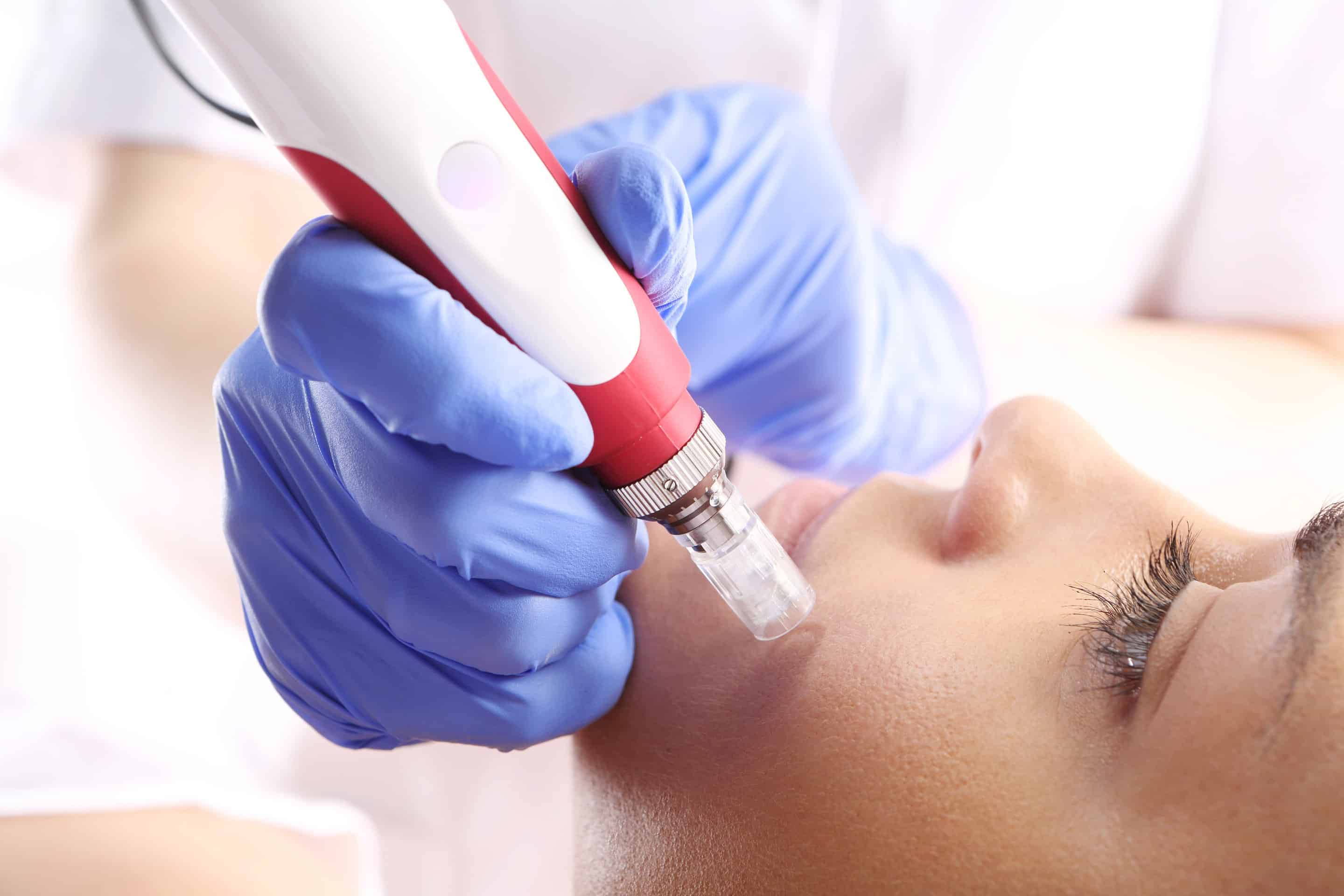 microneedling el paso