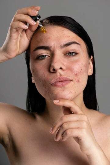 portrait-young-woman-being-confident-with-acne_23-2148982610