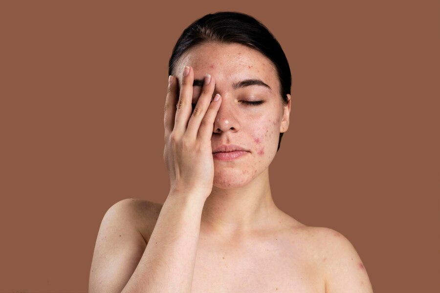 Acne-Prone Skin