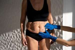 CoolSculpting