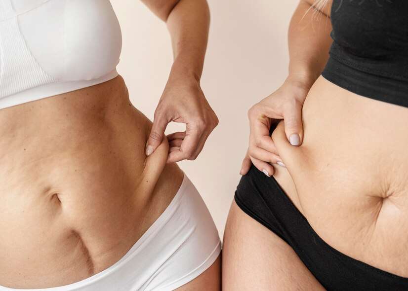 CoolSculpting vs. Liposuction (1)