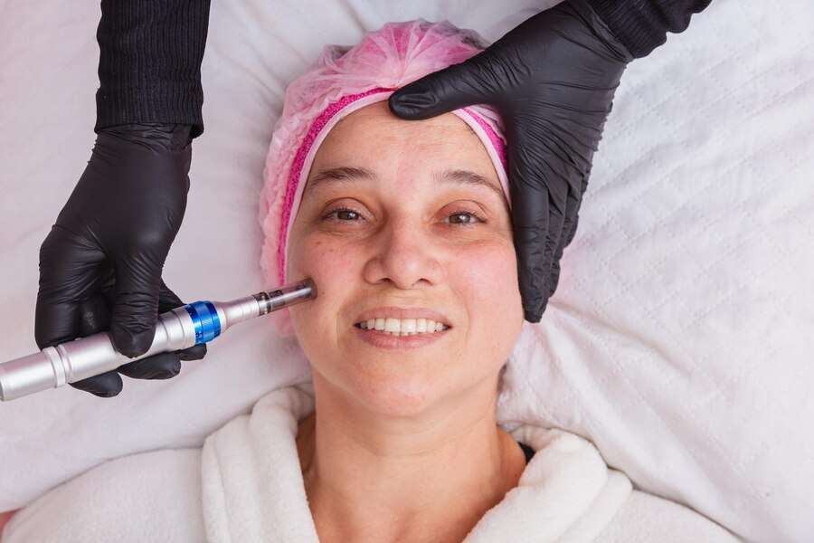 Microneedling (1)