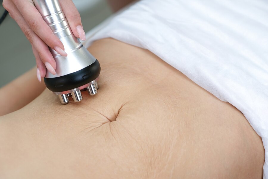 Microneedling (3)