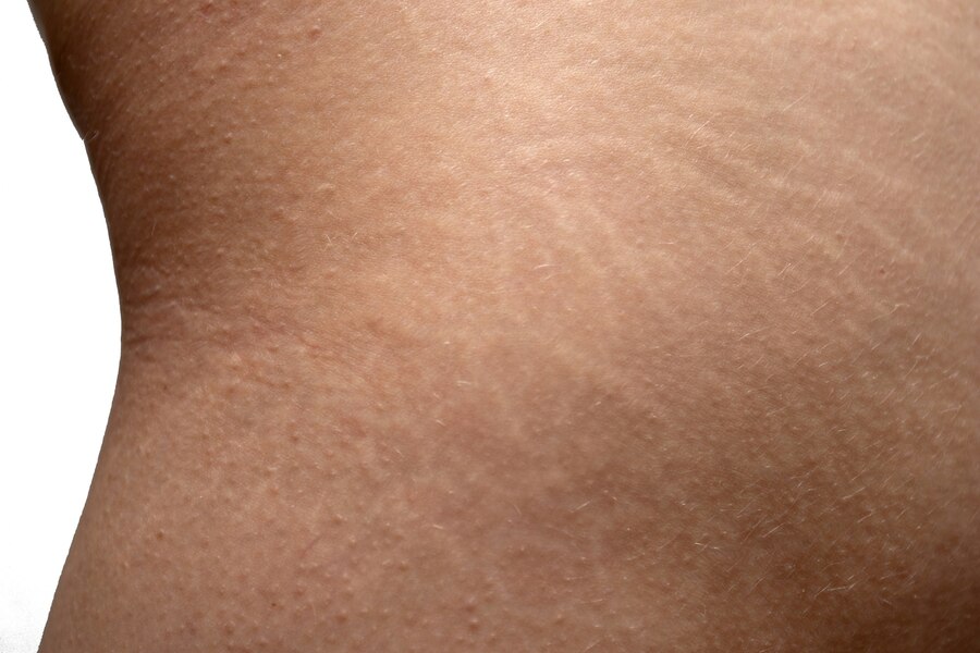Microneedling (4)