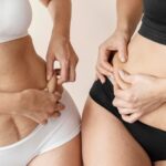 Benefits of CoolSculpting