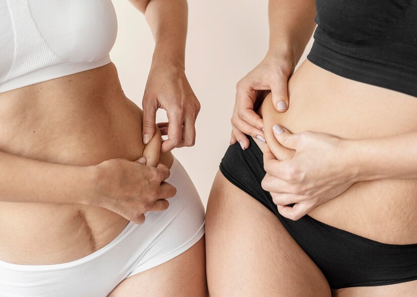 Benefits of CoolSculpting