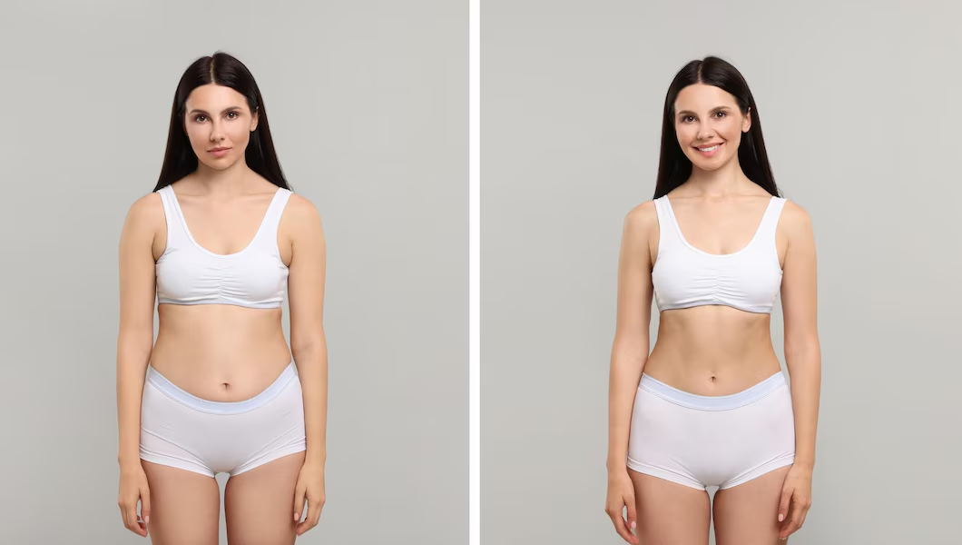 CoolSculpting Before and After Midland