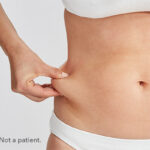 CoolSculpting Lubbock