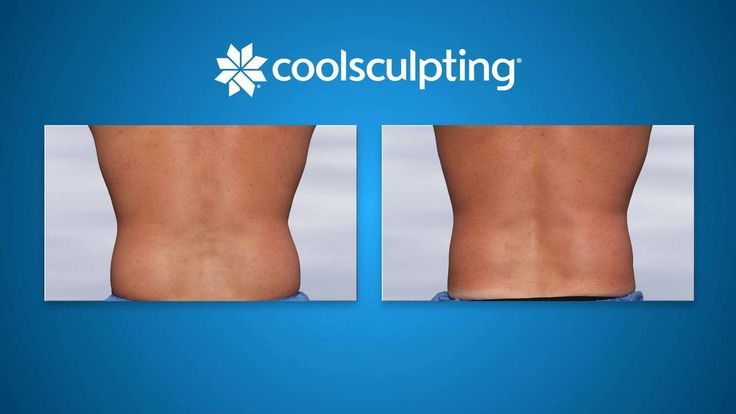 CoolSculpting