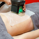 Fat Freezing