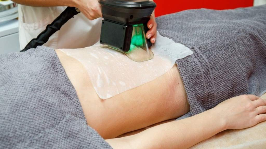 Fat Freezing