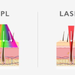 IPL vs Laser Hair Removal
