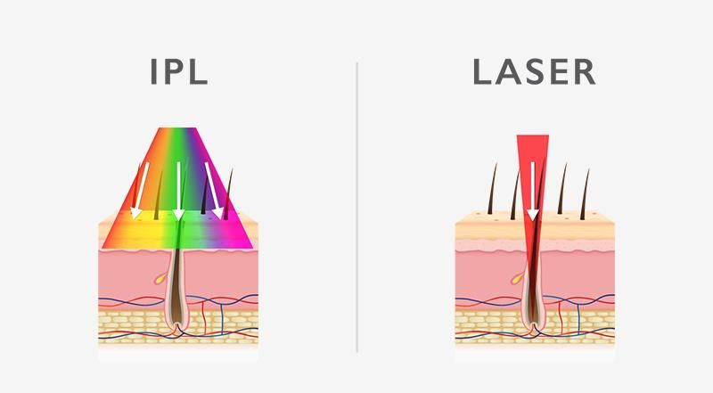 IPL vs Laser Hair Removal