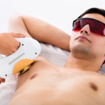 Laser Hair Removal for Men