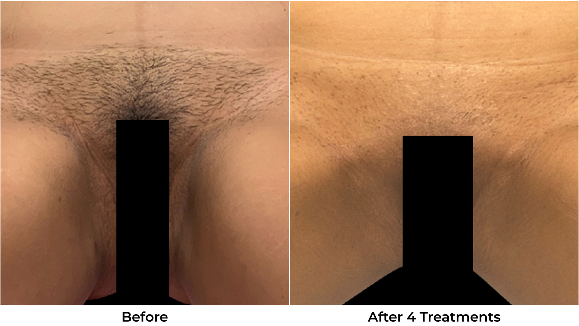 Laser Hair Removal Before & After Photos - Back