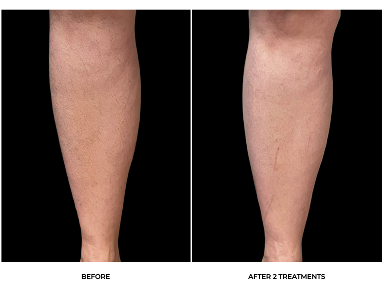 Laser Hair Removal Before & After Photos - Back