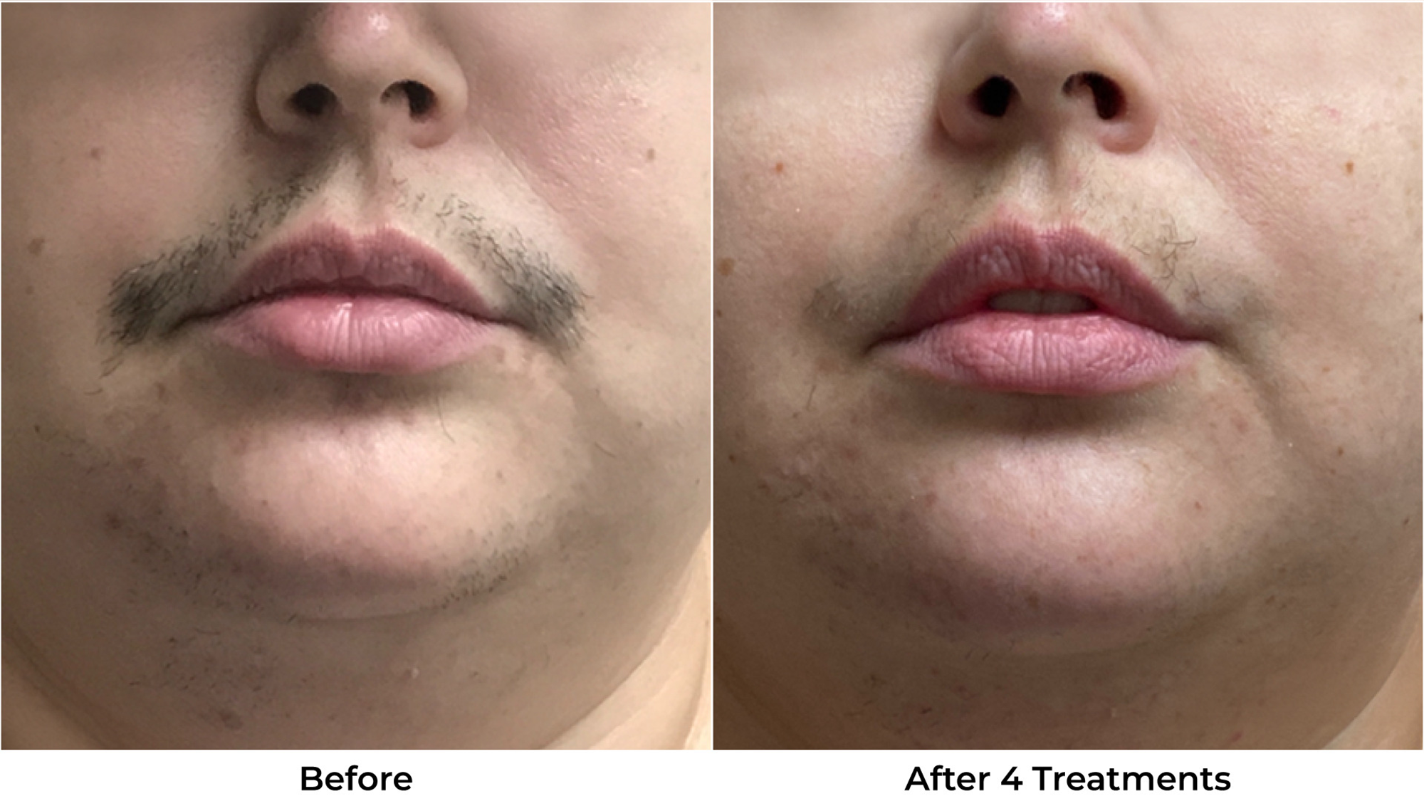 Laser Hair Removal Before & After Photos - Back