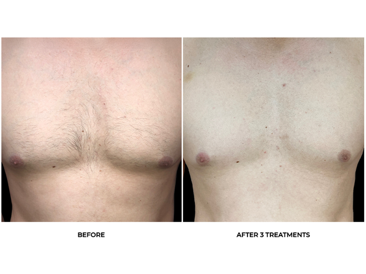 Laser Hair Removal Before & After Photos - Back