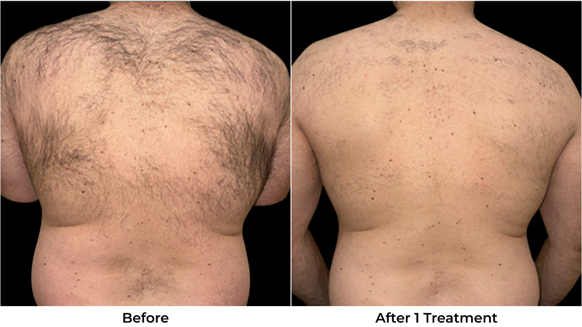 Laser Hair Removal Before & After Photos - Back