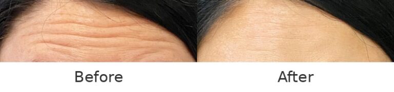 Botox