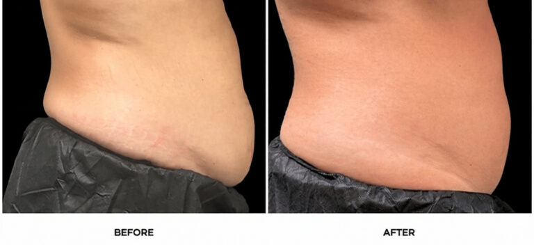 CS abdomen