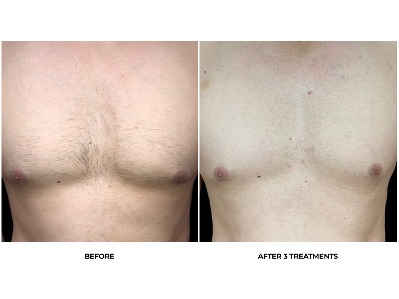 Laser Hair Removal Before & After Photos - Back
