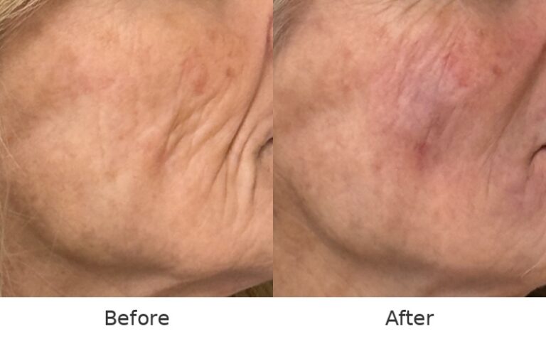 Juvederm