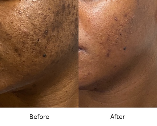 Microneedling