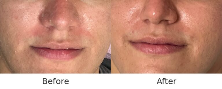 Ultra Sonic Facial