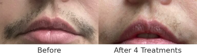 Upper Lip